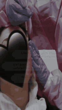 عروض الكريسماس من مجمع فيتامين
قسم التجميل الغير جراحي/

خصم 20% على جميع ابر النظارة والشد والابر العلاجية

خصم 15% على انواع البوتوكس والميزو بوتوكس

خصم 15% على فلر الوجه والشفة والوجنات

قسم مختبر التحليلات الطبية/

عرض الشامل فقط ب 35 الف

عرض السمنة والصحة البدنية واللياقة 35 الف

عرض تساقط الشعر 35 الف

عرض الخصوبة للجنسين والضعف الجنسي 40 الف 

قسم التمريض داخل العيادة او المنزلي كادر نسائي ورجالي لجميع مناطق بغداد 

تبديل الضماد ورفع خيوط العمليات الجراحية واعطاء الابر العضلية والوريدية والجلدية وشد ورفع الكانيولا 

الحرية شارع ٣٠ قرب اسواق مريومة فوق صيدلية شمس زيد كريم الطابق الاول 

يومياً من ساعة ١١ صباحاً حتى ٩ مساءً

*********** اتصال + واتساب

*********** اتصال فقط
