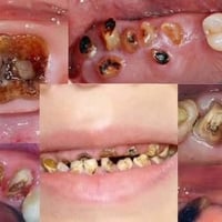 طقم كامل مجاني • قلع اسنان مجاني • الحلة شارع 40