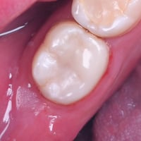 حشوة ضوئية • رحى سفلية • جلسة واحدة