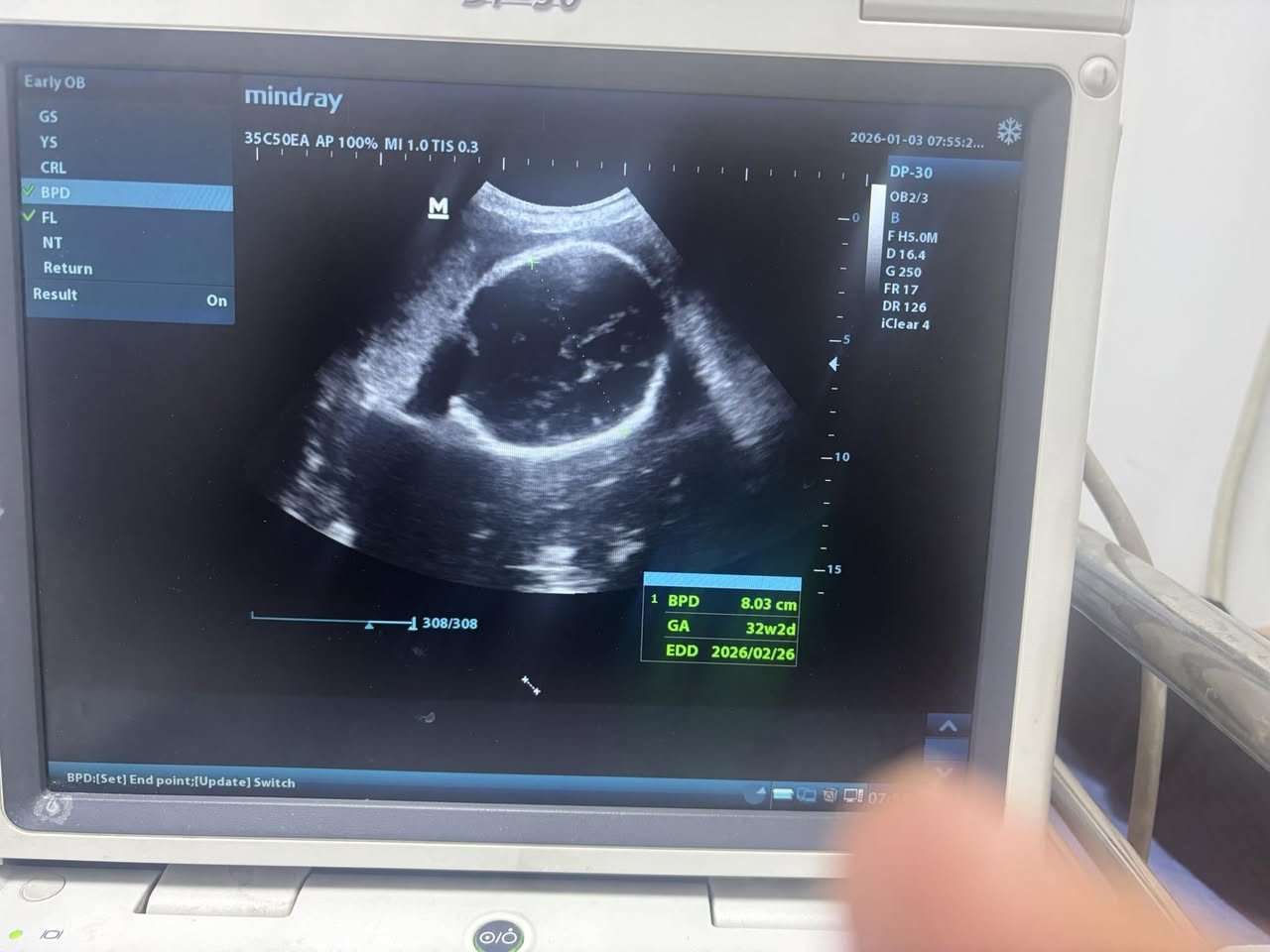 من حالات العياده
الي متابعه من الألف للياء وتطمن على سلامتها وسلامه النونو ربي يكونون بالسلامه ان شالله هي والنونو♥️🙏
ولد على ثنين بنوتات

د.انجي سعيد متي
بغداد/ابو دشير الشارع العام مجاور غذائيه ابو جواد
📍مجمع الحياه الطبي
كل ايام السبت والثنين واربعاء 
📩رقم الحجز ***********⁩
