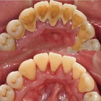عيادات الجامعة الاسلامية • تنظيف اسنان • مجاني