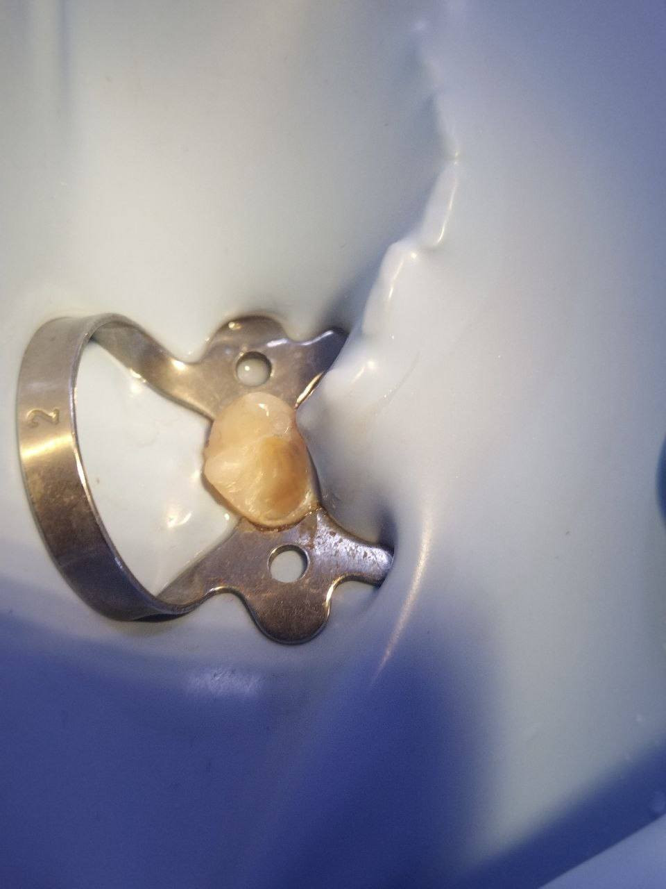 السلام عليكم

متوفر عدنا كافة علاجات الاسنان مثل
* الحشوه الضوئيه (التجميليه)
* تنظيف الاسنان وازالة التكلسات والتصبغات
* تعويض الاسنان المفقودة بطقم متحرك
* ازالة اسنان العقل
* ازالة الجذور التالفه(الي بقائها ممكن يسبب التهاب بالمكان او ممكن لتهيأة المساحه للزرعات المستقبليه)

🦷 العلاج مجاني وتحت اشراف كادر مختص
🦷 الموقع كلية الرشيد الجامعة

✨ زرعات الاسنان متوفره بس مو من ضمن العرض ومو بنفس الموقع اني بس اوصلكم للدكتور المناسب وبأسعار مناسبه للاستفسار عالخاص

🦷 *********** 
🦷 يوزر تيليغرام gagz_7
