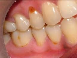 نستلم الحالات الي بالصورة العلاج مجاناً 
***********
