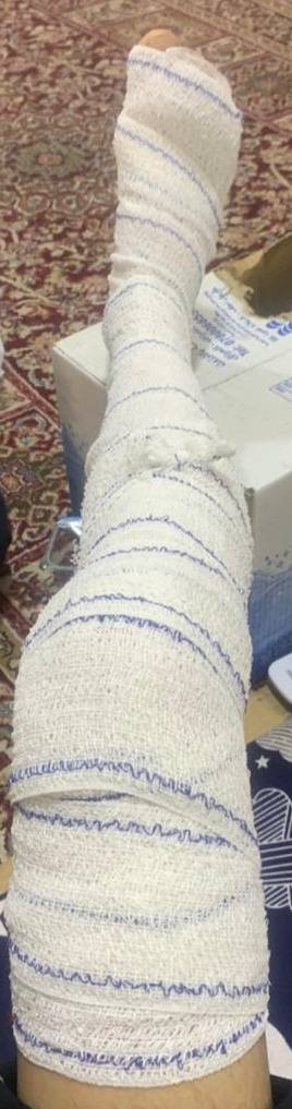 #ضماد_حرق_درجة_ثانية
يوجد لدى عيادتنا كادر متخصص لعلاج و متابعة حالة الحرق من اول يوم إلى حد اكتساب الشفاء التام و يكون الضماد و المتابعة منزلية لا تحتاج إلى زيارة العيادة او مركز الحروق
نختصر عليك الوقت و الجهد و التكلفة

للتواصل
*********** واتساب
*********** اتصال

الله يحفظكم من كل سوء 🤍

 الصور👇 من متابعتنا لشخص محترق بالغاز أثناء عمله في المطعم
يسكن في مجمع الاميرات الثاني

