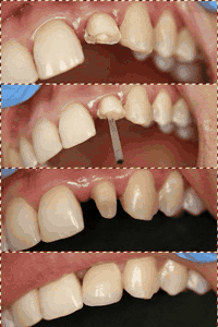 زراعة أسنان • تجميل أسنان • خانقين تولة فروش