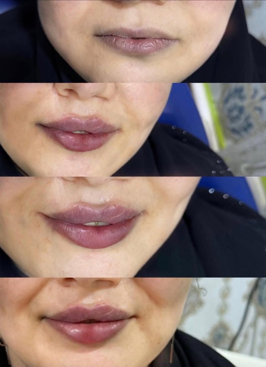 اليوم مسابقتنا غييير ❤️‍🔥❤️
صاحبة الصورة الي تحصل اكثر عدد من اللايكات 
تفوز ويانا بجلسة نضارة الريفتا مجانية❤️
شوفو الصور وسوو لايك
وسوو تاك لصديقاتكم يفوزوكم😍
كل فترة اختار كم صورة نسوي عليهم مسابقة حتى يفوزون مراجعاتنا الدائمات❤️❤️❤️😍


**إذا كنت صاحب هذا الإعلان وتريد حذفه لأي سبب، رجاءا أرسل رسالة إلى الدعم الفني**