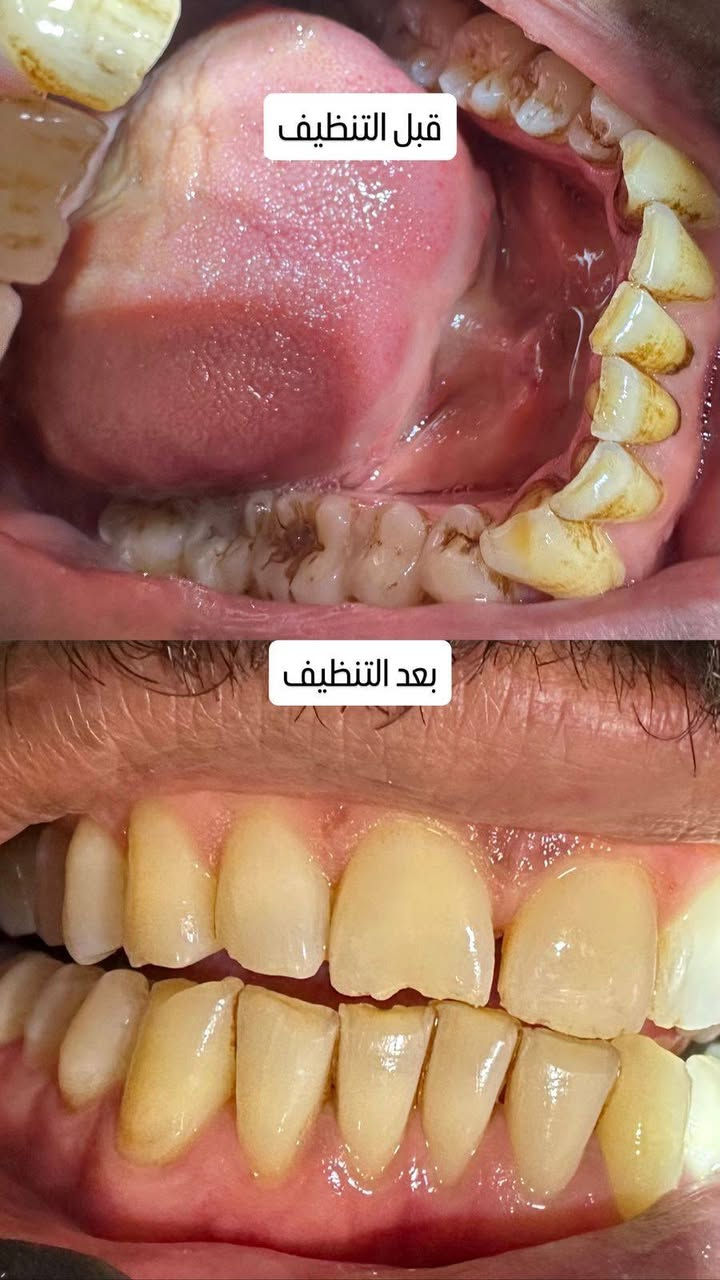 إذا تبحث عن العناية بأسنانك بأيدي خبير، زور عيادة الدكتور هاشم غسان.
✅ فحص وتشخيص دقيق

✅ علاج وحشوات الأسنان

✅ تنظيف وتلميع الأسنان

✅ سحب الأسنان

✅ تركيبات وتجميل الأسنان

نهتم براحتكم ونحرص على تقديم أفضل رعاية بابتسامة وثقة.

📍 العنوان: موجاور دكتوره حنين نجم جبوري)

📞 للحجز والاستفسار: (***********)

الدكتور هاشم غسان – لأن ابتسامتك تستحق الأفضل.
