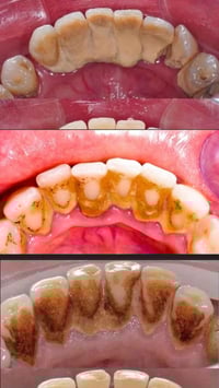 تنظيف اسنان • جامعة الانبار • حشوات جذور قلع