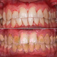 مرحبا محتاج تنظيف اسنان مجاني بشرط. يصور اسنانه ويدزهم يلا اشتغلهم اله...