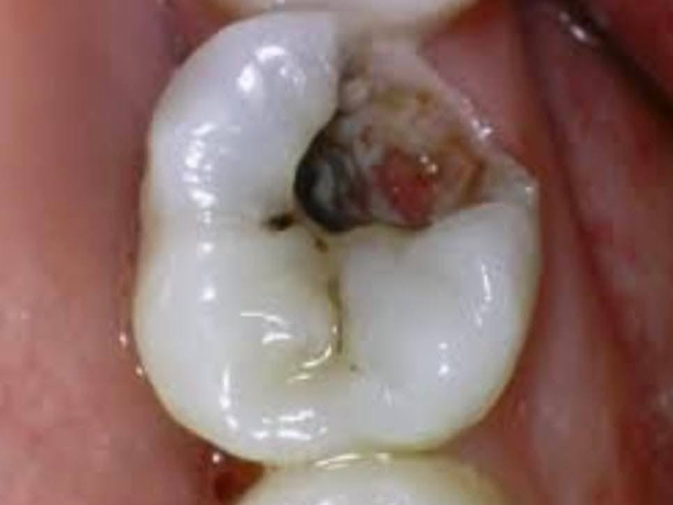 السلام عليكم
متوفر قلع للاسنان المتهالكة او بقايا جذور الاسنان مجانًا في عيادات كلية طب الأسنان جامعة الموصل

اللي يريد يحجز موعد او عنده اي اسفسار يراسلني


**إذا كنت صاحب هذا الإعلان وتريد حذفه لأي سبب، رجاءا أرسل رسالة إلى الدعم الفني**