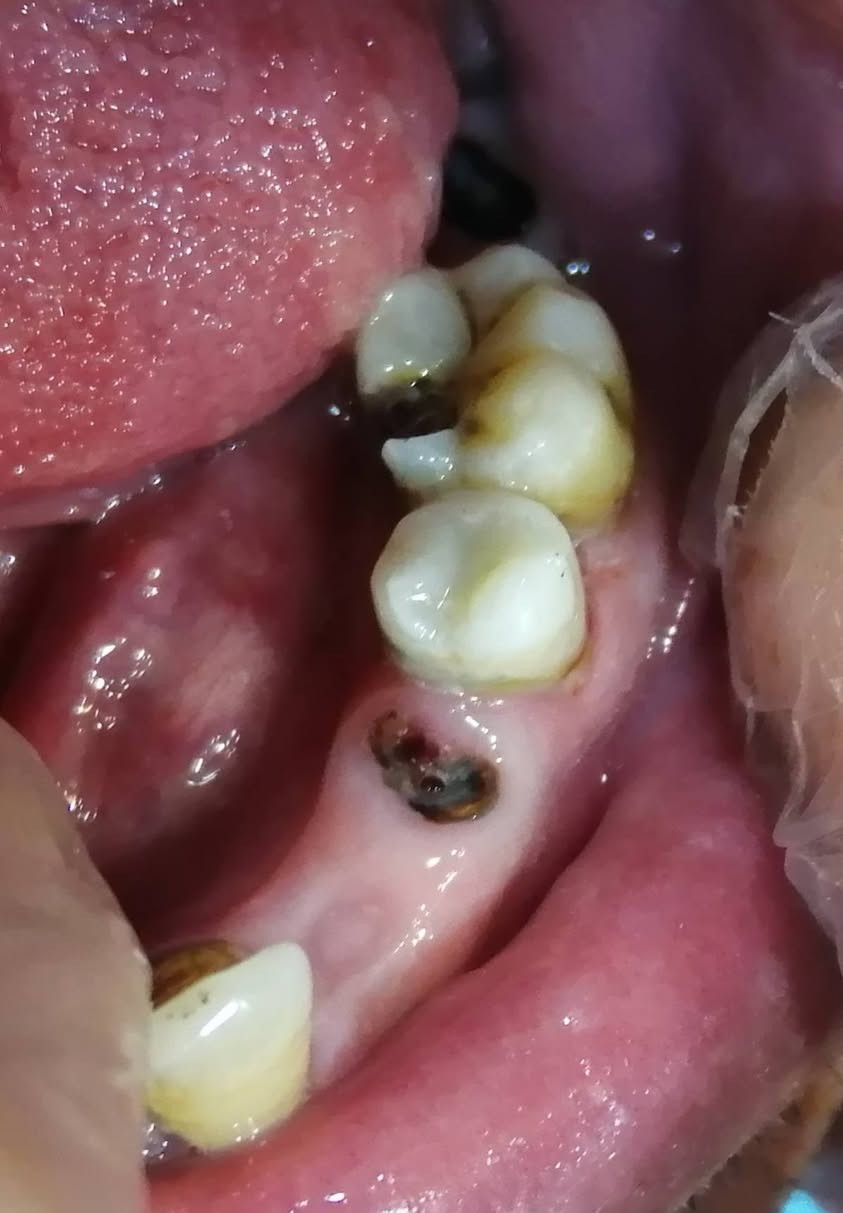 ترميم السن الضاحك السفلي بحشوه جذر مع حشوه تجميليه.. د مهند عبد الجواد الطحان.. ماجستير ودبلوم عالي تعويض الأسنان.. سايدين مستشفى القياره.. مقابل باب الطوارى.. مجاور صيدليه عبدالله المعماري.. طابق ارضى.. للحجز والاستفسار التواصل على الرقم ***********#
