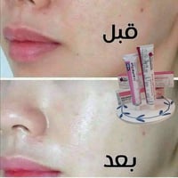 تفتيح البشرة • علاج الكلف • إزالة الهالات