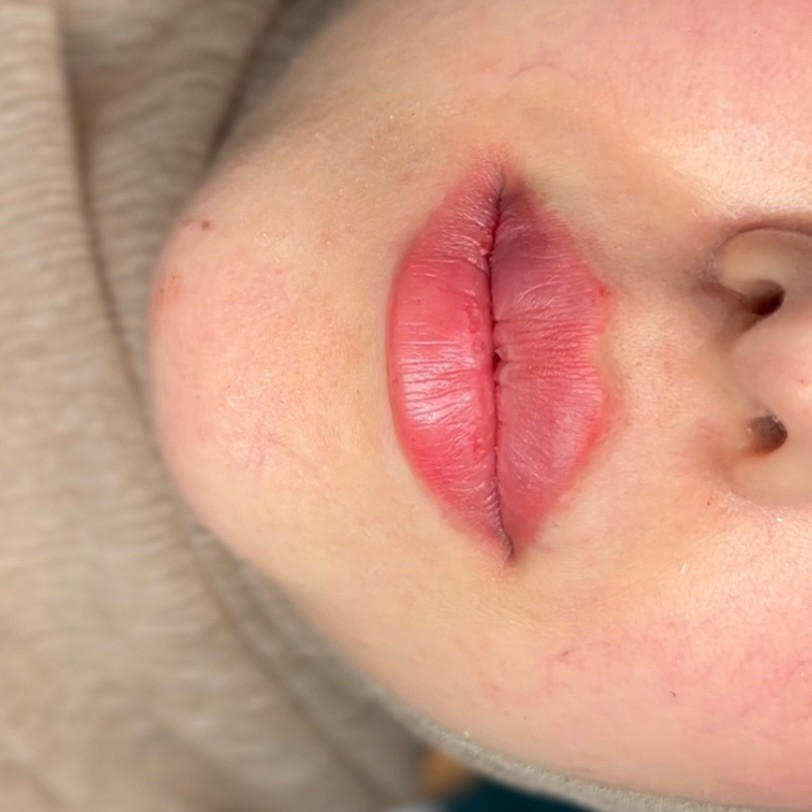 بدون رسم وحدود ==صارت ب رسم وحدود ب 1 سيسي فلر
د.علا هادي الشمري 

6*********** ‏📞
💋💋💉
#explore #explorar #explorer #lip #lipfillers
