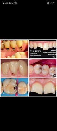 قلع أسنان • تنظيف أسنان • مجاناً