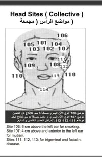 حجامة علاجية • علاج شامل • الهوير فلكة الخاص