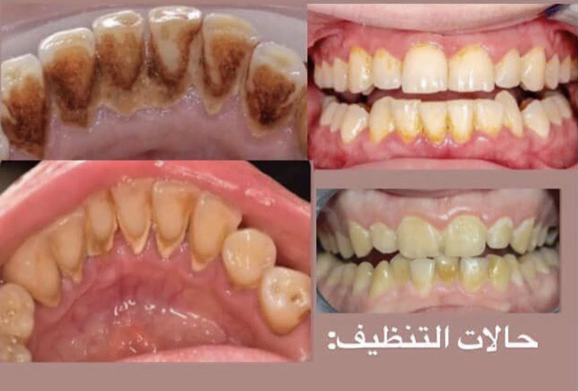 السلام عليكم  متوفر لدينا علاج مجاني بالكامل للحالات المذكورة 👇
1- حشوات تجميليه ( بيضاء) .🦷
2-قلع بقايا جذور الاسنان .🦷
3- تنظيف الاسنان وازالة التكلسات .🦷🪥
4- تعويض الاسنان المفقودة بطقم (تخم) متحرك .🦷

☎️للحجر او الاستفسار مراسلة الصفحة على
الماسنجر او واتساب 📞***********
