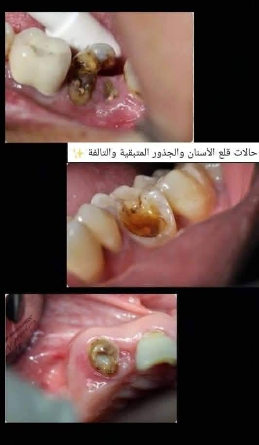 #خدمات_علاجيه_مجانيه_لطب_الفم_والاسنان
●  عيادة الاطفال 
تقويم للاطفال 
قلع الاسنان للاطفال
جلسة فلورايد لتعزيز وتقوية السن من التسوس
حشوات للاطفال 
●  جراحة الوجه والفكين 
قلع الأسنان والجذور التالفة 
معاينة كامله للفم 
قلع الاسنان جراحيا 
●صناعة الاسنان 
تعويض الاسنان المفقودة جزئيا اوكليا بطقم متحرك 
●تنظيف الاسنان وعلاج امراض اللثه 
●حشوات ضوئيه للاسنان 
الموقع حي النقيب شارع النهر 
علما ان العمل تحت اشراف اطباء اختصاص للحجز والاستفسار مراسلتي خاص او عبر الاتصال ع رقم ع واتساب ***********
