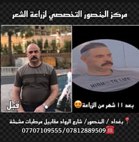 مو أي زراعة تنطي هيچ نتيجة  بكثافة طبيعية✅  وبدون فراغات✅  وبجلسة وحدة...