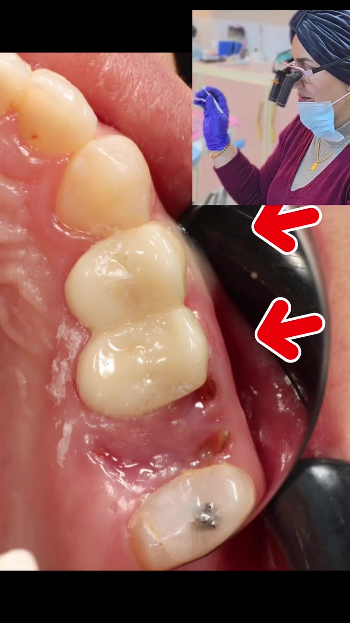 أغلفة زاركون تجميلية ..💯
🤗رجعنا الاسنان من متهالكه الى اسنان صحية من ناحية الشكل والوظيفه 👍👍🥰
بعقوبة مدخل شفته الرئيسي
*********** واتساب
اختصاص تجميل الاسنان🥰 خبرة ١٤ سنه بالعمل
