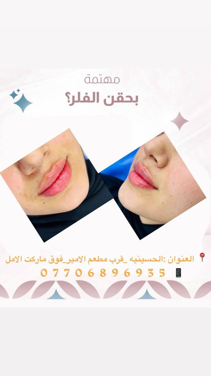 عيادة مصطفى التميمي للتجميل والليزر
لأن جمالك يستحق الأفضل 🌸
فلر _بوتكس _علاج حب الشباب _تقطيع الالياف _علاج تصبغات _سكن كير حسب نوع البشره _تنضيف بشره _ليزر
📍 الحسينية – قرب مطعم الأمير _فوق ماركت الامل _مجاور مطعم عمو باسم 
📞 ***********
عنوان الثقة والجمال الحقيقي ✨
خبرة، دقة، واهتمام بأدق التفاصيل
باستخدام أحدث الأجهزة وأفضل المواد
للحصول على نتائج طبيعية وآمنة 💎
نعتني ببشرتك حسب نوعها
ونقدّم حلول متكاملة للتجميل والعناية
جميع المواد المستخدمه داخل العياده مفحوصه وبراندات 
تنفتح كدام المراجع
