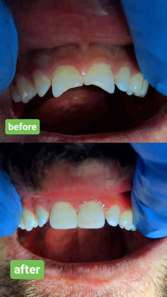 ⚡️ 30% خصم الآن!  عرض لا يُفوَّت! ⚡️

الدكتور وليد الفهداوي (بكالوريوس طب وجراحة الفم والأسنان
، سيرتفكت حشوات جذور ) يقدم :

​💰 العرض الأقوى (لفترة محدودة)!

​مجاناً: تنظيف وإزالة التكلسات والتصبغات عند حجز جلسة التبييض بالليزر!

​خصومات تصل إلى 30% على حشوات الضوئية و حشوات الجذور والقلع.

​فحص واستشارة مجانية لجميع الحجوزات.

​📞 احجز الآن!

للحجز ​اتصل على: ***********
العنوان: الرمادي _ الصوفية _ البومحل _ مجاور ملعب شهداء البومحل
