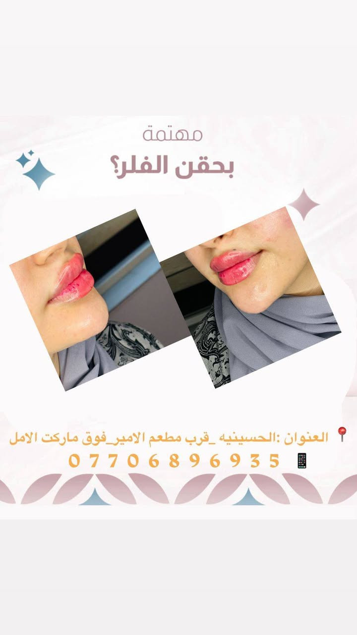 عيادة مصطفى التميمي للتجميل والليزر
لأن جمالك يستحق الأفضل 🌸
فلر _بوتكس _علاج حب الشباب _تقطيع الالياف _علاج تصبغات _سكن كير حسب نوع البشره _تنضيف بشره _ليزر
📍 الحسينية – قرب مطعم الأمير _فوق ماركت الامل _مجاور مطعم عمو باسم 
📞 ***********
عنوان الثقة والجمال الحقيقي ✨
خبرة، دقة، واهتمام بأدق التفاصيل
باستخدام أحدث الأجهزة وأفضل المواد
للحصول على نتائج طبيعية وآمنة 💎
نعتني ببشرتك حسب نوعها
ونقدّم حلول متكاملة للتجميل والعناية
جميع المواد المستخدمه داخل العياده مفحوصه وبراندات 
تنفتح كدام المراجع
