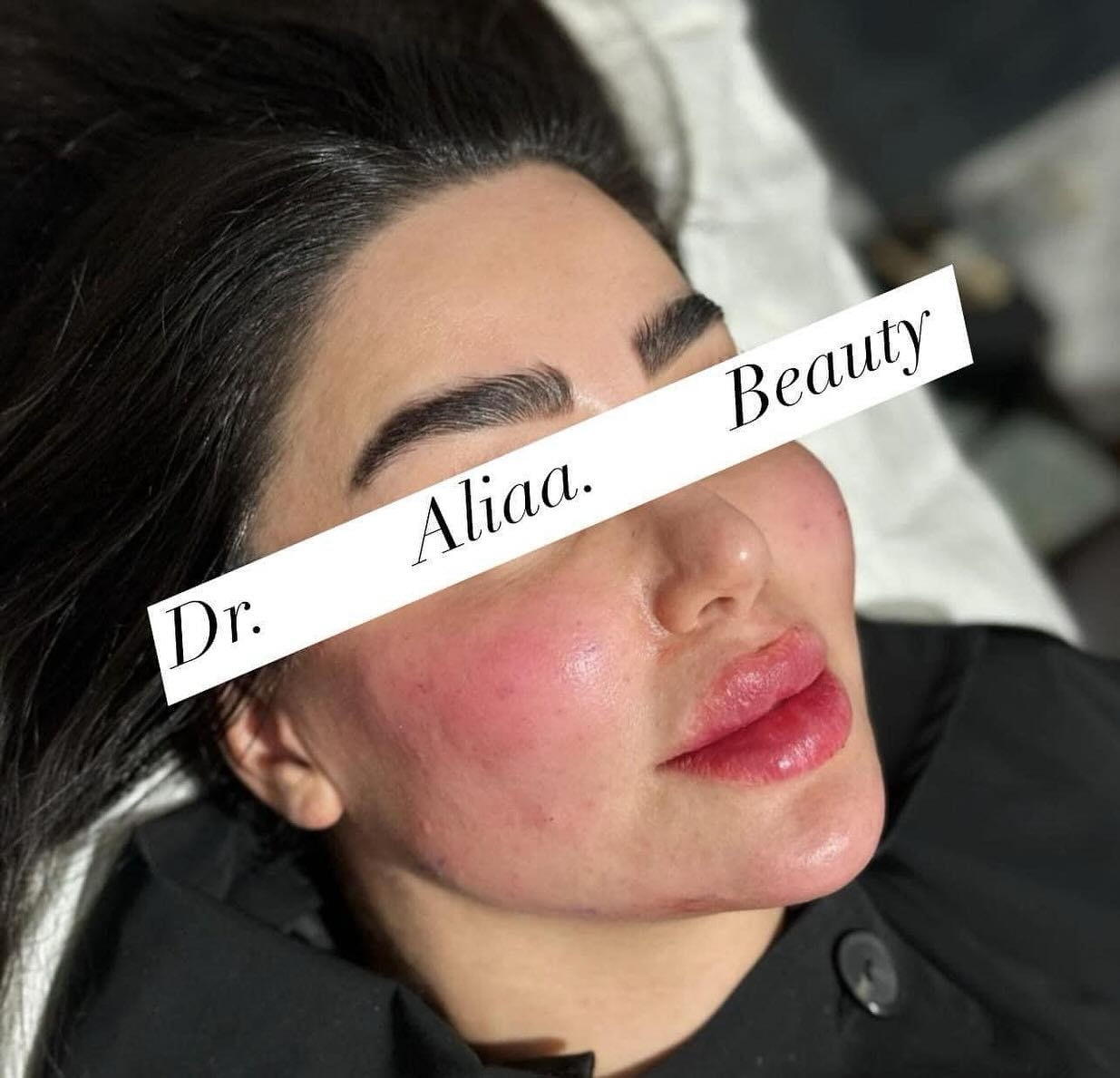 العروض الاقوى في بغداد لجميلات عيادتنة
فيلر الشفاه الكوري💋 50الف فقط  
💉 فيلر تكساس (10 إبر) فقط250 ألف😍  
 إبرة العنبر 10cc* فقط 150 ألف  
👰 إبرة العروسة فقط 50 ألف ❤ 
ابرة الريفتال ب75الف 
⚡ شد الجبين بالبوتوكس فقط 120ألف  
✨شد الوجه بالخيوط غير الجراحية – 8 خيوط
 فقط 300 ألف
فلر بدي ال60سيسي فقط ب500الف 
جلسة معالج الكميائي فقط 75الف 
 

🌸 عرض الصديقات! 😍 
كل 2 صديقات ياخذن فيلر شفة،  
الصديقة الثالثة فيلر شفة + تنظيف بشرة مجاناً!

💆‍♀️تنظيف البشرة العميق الملكي فقط 30 ألف  
🌟 جلسة إزالة الكلف والتصبغات فقط 50 ألف  
(مع جلسة نظارة مجانية)  
👃جلسة تذويب دهون الأنف بدون جراحة فقط 50 ألف
عرض اليزر بجهاز الكاندلا البارد المنطقة فقط15الف 
الفول بدي فقط ب65الف
📍 *الموقع:* بغداد – حي الاعلام  
📞 *للاستفسار:* ***********  
احجزي الآن قبل نفاد المواعيد!

--- ⁩
