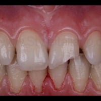 طالبة طب اسنان • حشوات بيضاء مجانية • اسنان خلفية امامية