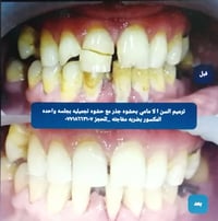 ترميم سن امامي • د مهند الطحان • مجاور صيدلية عبدالله