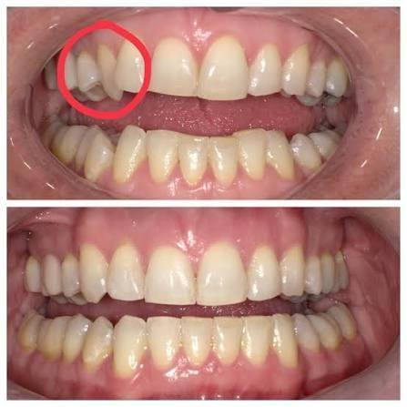 السلام عليكم 
الي محتاج علاج تقويم مثل هل حالات  بلصور لعمر 15 واقل مجانا يراسل علرقم ***********
من شهر الثاني نبلش فراح اثبت فقط لطفل واحد الي يريد يراسل
