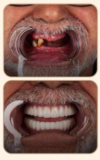 مجاناً✨✨✨🦋 لمن لديه - اسنان مفقودة  - ⁠.جذور متبقية   .اسنان مفقودة وح...