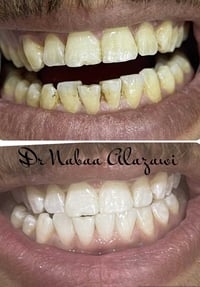 تبييض الأسنان بالليزر🦷✨🔥 للحجز و الاستفسار☎️07748570864