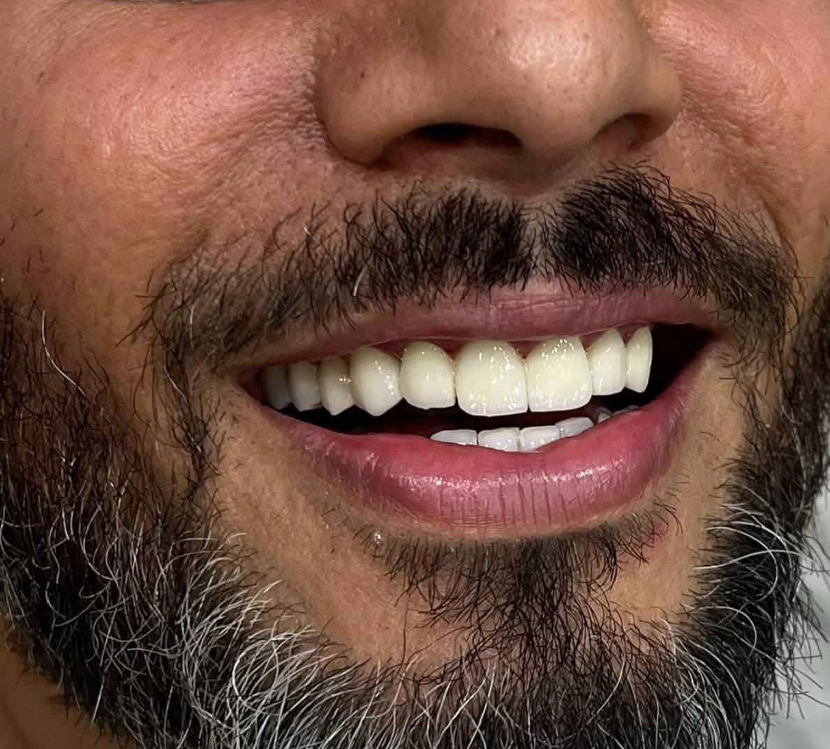 ابتسامة  ساحره وثقة مضاعفه 🩵🔥 عيادتنا فرع حي النصر 🔥🔥

ابتسامة هوليوود باستخدام (  زاركون ايماكس ألالماني) لمراجعنا من بغداد الجديدة 
ونتيجة رائعة جدا بابتسامة أنيقة 😍

على يد الطبيب الاختصاص🥼
د.محمد منصور 🔥
(ماجستير في طب ومعالجة الاسنان) 🦷

أبتسامتك ~ يم عيادات الفرح لطب وتجميل الأسنان ~ غير ✨😍

علماً كافة الابتسامات والحشوات مع ضمان مدى الحياة 😎

للإتصال 📞📞 
فرع حي النصر
#العنوان
حي النصر/ شارع الاطباء / قرب جامع الأمام المهدي
فوق صيدلية مصطفى جاسم أو أسواق الزعيم 
للحجز والاستفسار 👇

*********** ☎️

دوام العياده ⏰
فرع حي النصر 
من الساعه 5  عصرا 
إلى 
الساعه 10 مساءا
