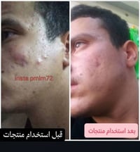 ✨ بشرتك تستاهل الفرق ✨  📌 شوفوا النتيجة المبهرة لزبوننا الغالي بعد 3 أ...