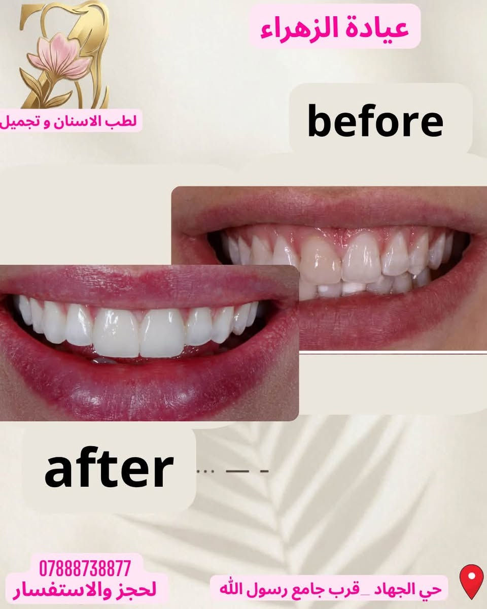 تغيير جذري لابتسامتك بجلسة واحدة بس! ✨🦷 احجز موعدك ويا عيادة الزهراء وشوف الفرق بنفسك."رأيكم بالنتيجة؟ للحجز والاستفسارتواصل على الصفحة 📩***********
