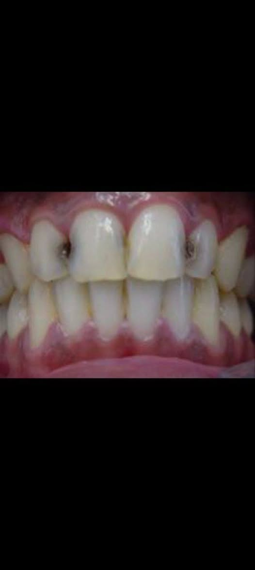 السلام عليكم اللي محتاج حشوة مجانية وعندة مثل هاي الحالات يتواصل واتساب ***********  جامعة الهادي نهاية شارع 60 قرب كنيسة بولص وبطرس
