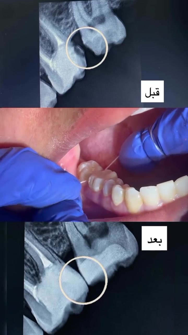 المراجعه تعاني من تجمع الاكل بين اسنانها 
السبب: تسوس في الرَحى الاخيره 
والرَحى القبلها سابقاً بيها حشوه معموله بطريقة خاطئه وبدون اتصال صحيح بين الاسنان 

عالجنا التسوس وتم اعادة الحشوة القديمه وحصلنا اتصال صحيح بين الاسنان حتى نتجنب تجمع الاكل ونتجنب التسوس يرجع . 
والأشعه توضح هالكلام  واستخدام خيط الاسنان بشكل صحيح بينهم وبالتحديد يطلع هذا الصوت ، هذا اقوى دليل ع الاتصال الصحيح بينهم . 
صحكتم امانه عدنا💙
📌عيادة الغدير لطب وتجميل الأسنان 
📍قرب فلكة الصدرين /بناية الدكتور الصيدلاني علي هاشم الموسوي 
يتواجد بيها الدكتور علي حسين داود 

📞***********

