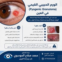 ورم حبيبي قيحي • طب العيون • كربلاء طويريج