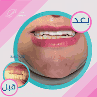 ضحكتها صارت تحچي ❤️‍🔥!

كانت تضحك… بس تحاول تخفي الجزء العلوي من أسنانها لأن ماكو ولا سن ظاهر…
وبجلسة واحدة داخل عيادات بلاتينيوم لطب الأسنان، قدرنا نرجع الضحكة بكامل ثقتها ✨
ركبنا لها ابتسامة متكاملة للفك العلوي بأسنان عالية الجودة، لون طبيعي، تصميم دقيق، وثبات مثالي!
والنتيجة؟ ضحكة تشد الانتباه وراحة نفسية ما تنوصف 😍

📍تركيب الأسنان يتم على يد كادر اختصاص بخبرة طويلة
🦷 مواد عالمية، وتقنيات تعقيم حديثة بسولوكس
🕓 مدة الجلسة: حسب الحالة – أغلبها ما تتجاوز 60 دقيقة
🛡️ ضمان حقيقي على التركيبات
💰 أسعار مدروسة وتقسيط متاح

📸 الصورة تتكلم: قبل ماكو سن ظاهر، بعد… ابتسامة تفتح النفس!

📞 للحجز والاستفسار:
*********** – ***********
📍بغداد – المحمودية – حي ١٧ تموز – مجاور منفذ كرار الطائي

خلي ابتسامتك تحچي مثلك – بلاتينيوم سنتر

#ابتسامة_الثقة #تركيبات_أسنان #بلاتينيوم_كلينك #بغداد #ابتسامة_قبل_وبعد #الفك_العلوي #HollywoodSmile
