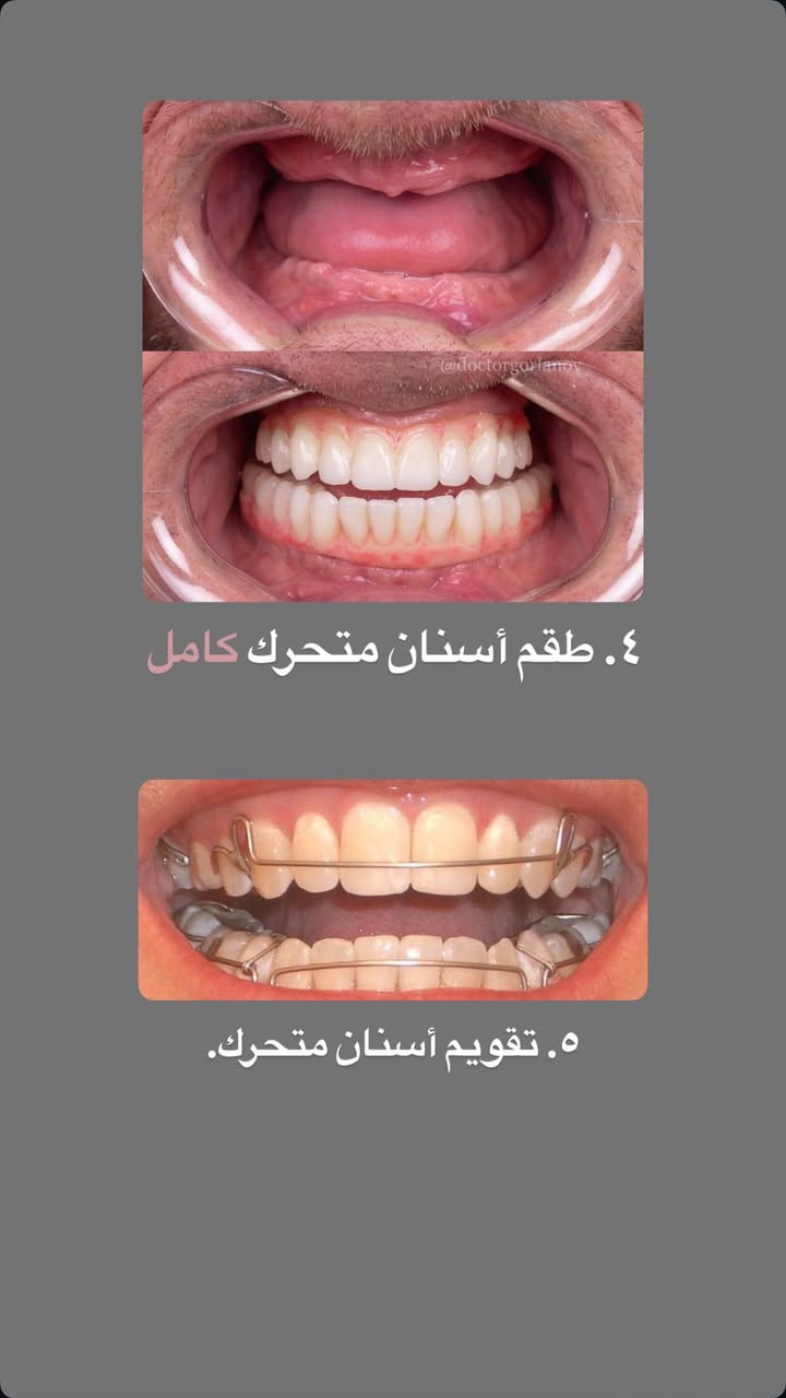 السلام عليكم ورحمة اللّٰه وبركاته 🦷🪥
الى كل من يحتاج رعاية طبية لأسنانه وذلك من

🔴حشوات تجميلية بيضاء
🔴حشوات جذور
🔴قلع الاسنان التالفة او الجذور المتبقية
🔴تنطيف التكلسات القوية
🔴قلع أسنان الاطفال
🔴تقويم أسنان للاطفال
جميع هذه الخدمات متوفرة في العيادات التعليمية لجامعة ذي قار علماً بأن العلاج مجاني ماعدا تكلفة الباص .
وهذه بعض من الحالات التي تم علاجها على يد 
الدكتورة: غدير جاسم محمد / المرحلة الخامسة
العنوان: حي اور / كلية طب الاسنان مقابل مستشفى الحسين التعليمي فرع الطب العدلي
للحجز: التواصل على الخاص او الرقم *********** او على حساب الانستكرام
gh_clinic0
