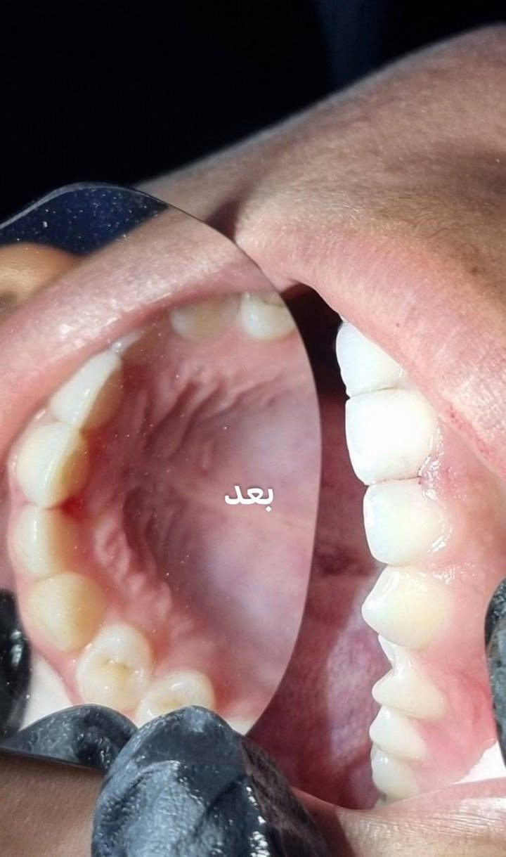 من أعمالنا اليومية في عيادتنا💙

إعادة عمل حشوة ضوئيه للاسنان الاماميه
 بحشوة تجميلية
وارجاع شكل الابتسامة الصحيح✨🦷..

#عيادة_كوثى_لطب_وتجميل_الاسنان
#الدكتور_علي_حسن_العزاوي 
جبله/نهاية شارع الاطباء
مقابيل الدكتوره ميثاق المعموري

***********//للاستفسار

