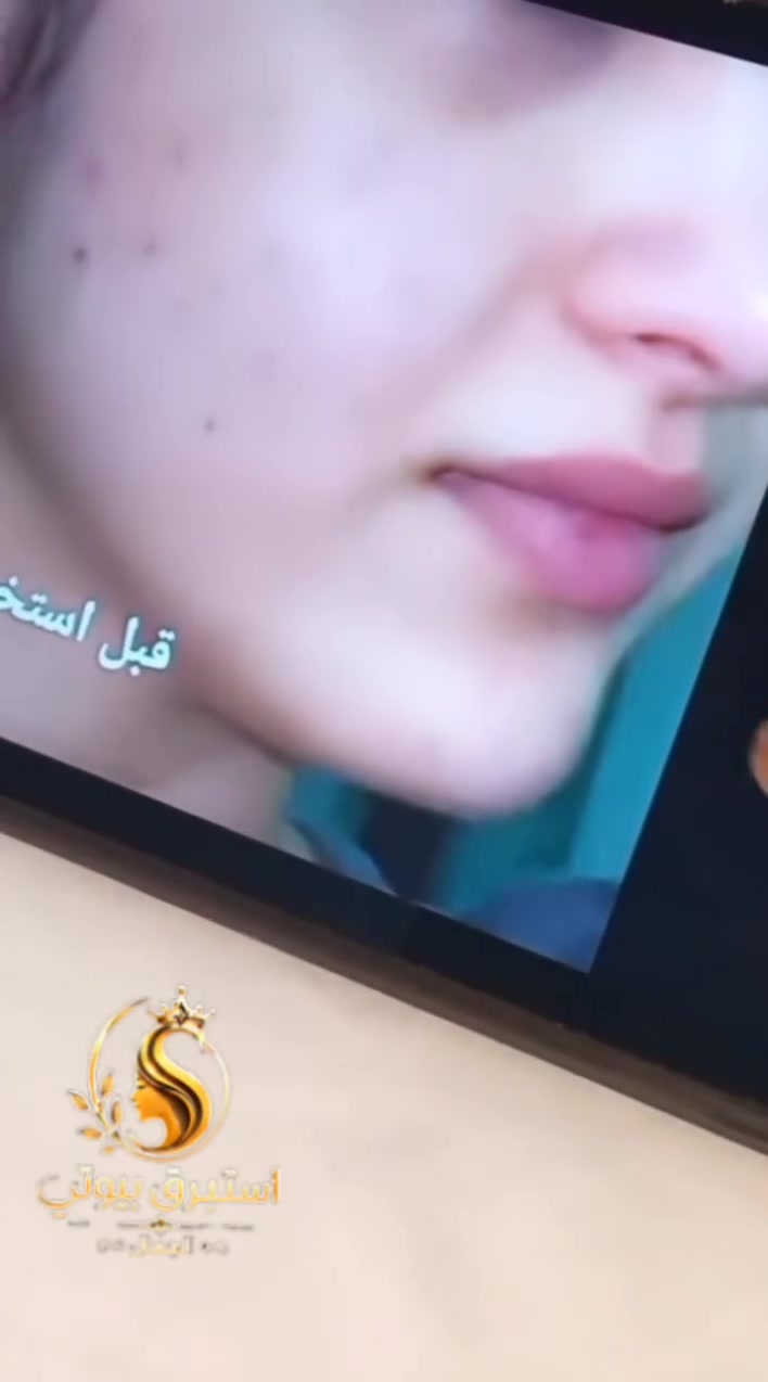 ✨ 15 يوم فقط من الاستخدام... والفرق بدأ يبان! 💙

سعيدة جداً بمشاركة تجربة زبونتي الجميلة بعد استخدام كريم الكولاجين البحري، وبعد 15 يوم لاحظت بنفسها التغيير والاهتمام ببشرتها ✨

شكراً لثقتكم الغالية، ودايماً النتائج تختلف من شخص لآخر حسب طبيعة البشرة والالتزام بالاستخدام 🌸

💎 العناية اليومية هي سر الإشراقة والثقة. 📩 للحجز والاستفسار راسلينا، والعروض مستمرة لفترة محدودة.

#تجارب_زبوناتنا #كولاجين_بحري #عناية_بالبشرة #ثقة_وجمال #نتائج_مرضية 💙✨


**إذا كنت صاحب هذا الإعلان وتريد حذفه لأي سبب، رجاءا أرسل رسالة إلى الدعم الفني**