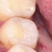 دكتوره بالوطنيه • حشوه ضوئية بلاش • نظيفه