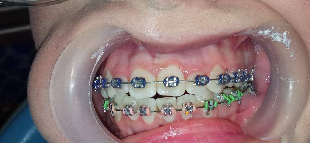 عياده الدكتور عماد عطا الله البدري
لزراعه وتقويم الاسنان رقم عياده ***********
