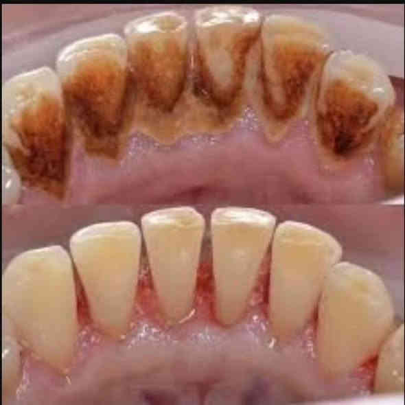 السلام عليكم تعلن عيادات جامعة بابل / كلية طب الاسنان 
إستقبال الحالات التالية  (مجانا) فقط سعر الباص  :
1_قلع الاسنان والجذور التالفه.
2-حشوات دائمية ضوئية وحشوات جذور.
3-تعويض الاسنان المفقودة بطقم كلي 
4-تنظيف الاسنان وازالة التكلسات.
5- معالجة اسنان الاطفال(قلع الاسنان اللبنية/حشوات/تنظيف/وقاية الاسنان من التسوس بإستخدام الفلورايد).
6_  تقويم اسنان متحرك
7_ مشاكل في الفك الصدغي وتقرحات في الفم واللسان 
 للحجز والاستفسار تواصل على الخاص 
او واتساب على الرقم📞 :-  ***********
العنوان🗺 : عيادات طب الاسنان_ حي الاسكان_ قرب الكراج الموحد
