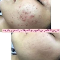 تبييض ٣ أيام • ازالة الكلف • طبيعي ١٠٠٪