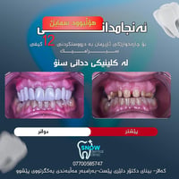 هوليوود سمايل • فينير سيراميك • كەلار