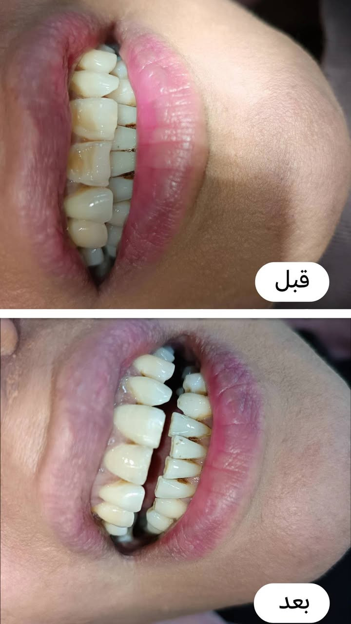 📢 إعلان لمرضى الأسنان 🦷✨
أنا طالبة طب أسنان - المرحلة الخامسة في جامعة دجلة. 
أعمل حاليًا على استقبال حالات علاجية داخل الكلية وتحت إشراف مباشر من أساتذة وأطباء متخصصين لضمان أفضل رعاية ممكنة.

🔹 تتوفر العلاجات التالية مجانًا/بأسعار رمزية (حسب نظام الكلية):

الحشوات التجميلية والعلاجية.

تنظيف الأسنان وإزالة الترسبات الجيرية.

علاج الجذور (حشوة العصب).

معالجة اللثة البسيطة.

أطقم الأسنان الجزئية والكاملة

علاج اسنان الاطفال 

✅ العلاج يتم بجودة عالية وتحت متابعة مشددة من الكادر الطبي.
✅ فرصة للاستفادة من خدمات أسنان آمنة واحترافية.

📍 المكان: الدورة - شارع المصافي / كلية دجلة الجامعة 
📞 للتواصل وحجز الحالة: ماسنجر /او عبر الرقم في الكارت


**إذا كنت صاحب هذا الإعلان وتريد حذفه لأي سبب، رجاءا أرسل رسالة إلى الدعم الفني**