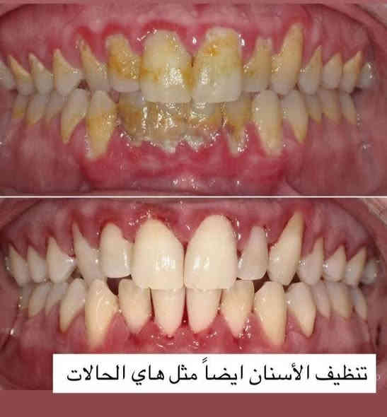 العلاج #مجاني لفترة محدودة
تعلن عيادات طب الاسنان في جامعة الكوفة عن استقبال المراجعين الذين يعانون من :
1- تكلسات وتصبغات الأسنان (تنظيف الأسنان) 
2-قلع الاسنان التالفة وبقايا الجذور
3- ازالة جميع التسوسات وعمل حشوات تجميلة
4- تعويض الأسنان المفقودة بطقم جزئي متحرك
للأستفسار اكثر مراسلة صفحتنا 
او عن طريق الواتساب ***********

#صحة #اسنان #مجاني #اهتمام #رخيص
