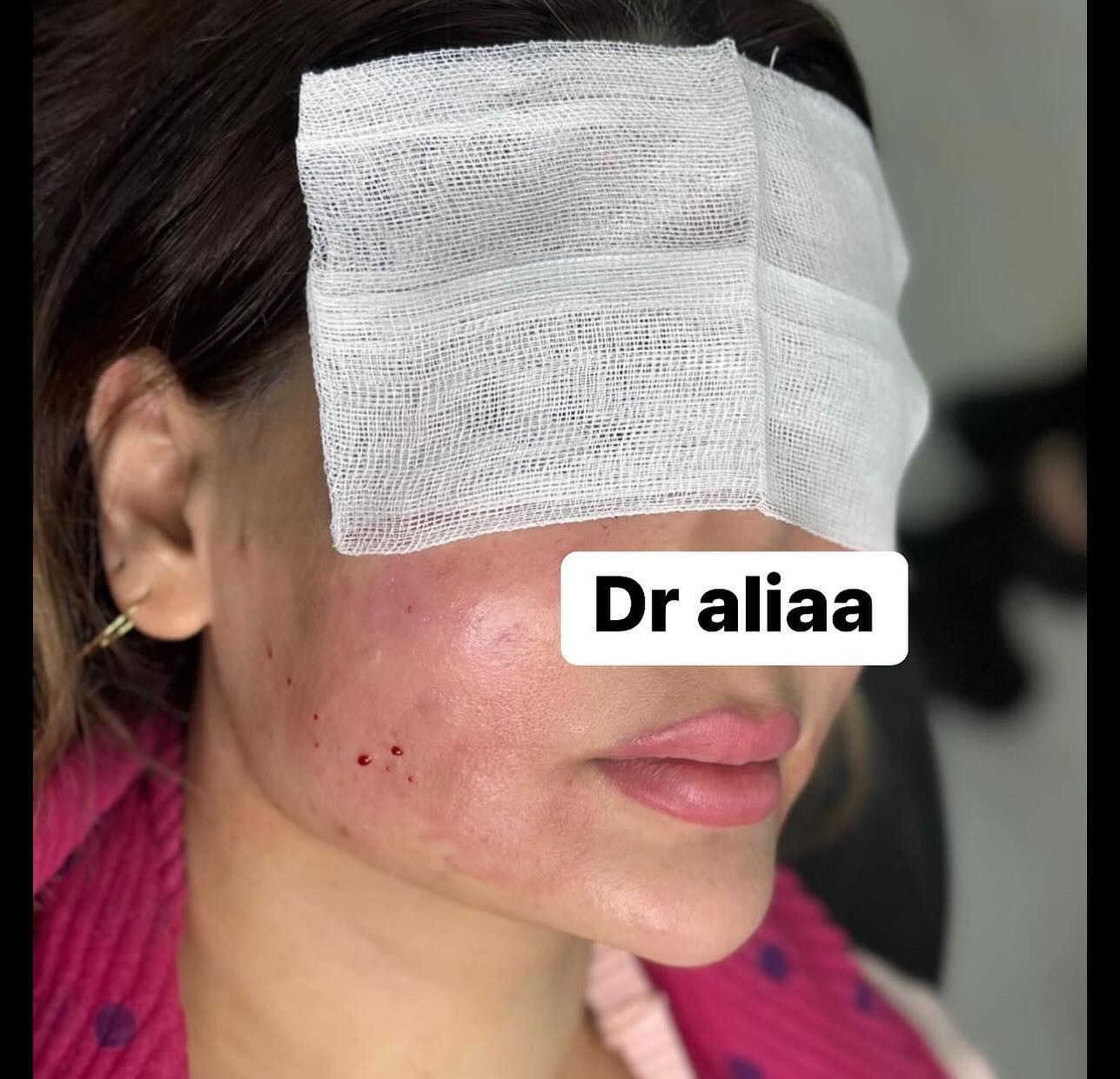 العروض الاقوى في بغداد لجميلات عيادتنة
فيلر الشفاه الكوري💋 50الف فقط  
💉 فيلر تكساس (10 إبر) فقط250 ألف😍  
 إبرة العنبر 10cc* فقط 150 ألف  
👰 إبرة العروسة فقط 50 ألف ❤ 
ابرة الريفتال ب75الف 
⚡ شد الجبين بالبوتوكس فقط 120ألف  
✨شد الوجه بالخيوط غير الجراحية – 8 خيوط
 فقط 300 ألف
فلر بدي ال60سيسي فقط ب500الف 
جلسة معالج الكميائي فقط 75الف 
 

🌸 عرض الصديقات! 😍 
كل 2 صديقات ياخذن فيلر شفة،  
الصديقة الثالثة فيلر شفة + تنظيف بشرة مجاناً!

💆‍♀️تنظيف البشرة العميق الملكي فقط 30 ألف  
🌟 جلسة إزالة الكلف والتصبغات فقط 50 ألف  
(مع جلسة نظارة مجانية)  
👃جلسة تذويب دهون الأنف بدون جراحة فقط 50 ألف
عرض اليزر بجهاز الكاندلا البارد المنطقة فقط15الف 
الفول بدي فقط ب65الف
📍 *الموقع:* بغداد – حي الاعلام  
📞 *للاستفسار:* ***********  
احجزي الآن قبل نفاد المواعيد!

--- ⁩
